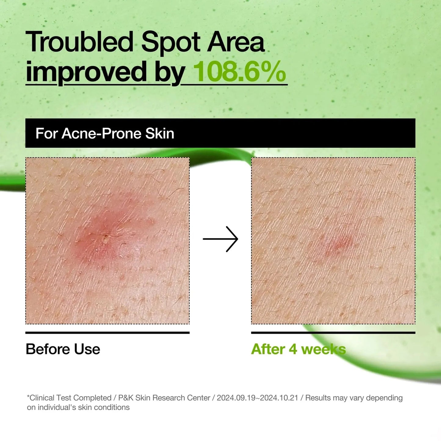 Anua Azelaic Acid 10 Hyaluron Redness Soothing Serum for redness
