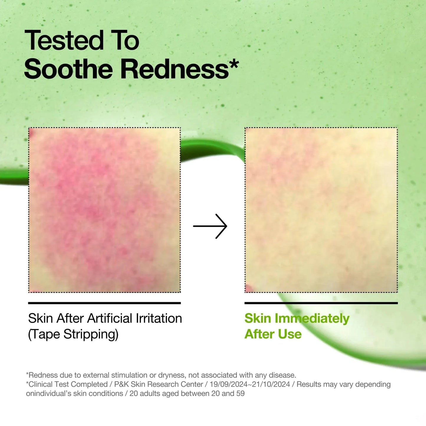 Anua Azelaic Acid 10 Hyaluron Redness Soothing Serum for sensitive skin